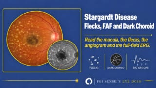 Stargardt Disease: Flecks, FAF and Dark Choroid. Illustrated fundus with macular atrophy and yellow flecks, and an autofluorescence inset