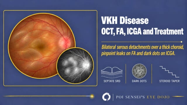 VKH disease thumbnail: a fundus photograph with serous retinal detachments and a swollen disc, and a fluorescein angiogram with pooled dye