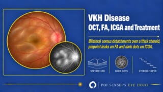VKH disease thumbnail: a fundus photograph with serous retinal detachments and a swollen disc, and a fluorescein angiogram with pooled dye