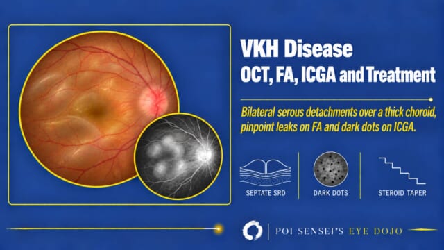 VKH disease thumbnail: a fundus photograph with serous retinal detachments and a swollen disc, and a fluorescein angiogram with pooled dye