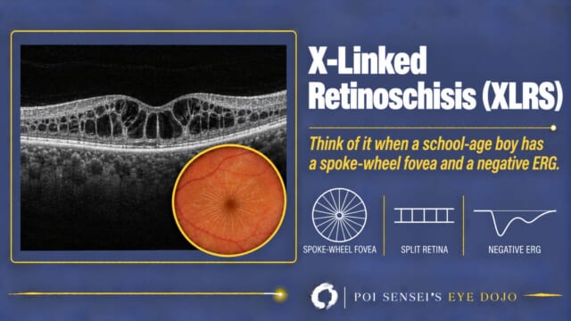 X-linked retinoschisis: OCT with schisis cavities inside the retina and a spoke-wheel fovea