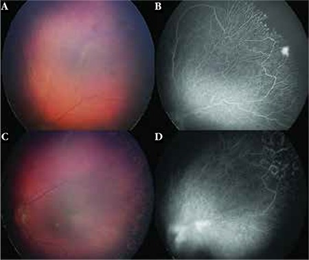 Color fundus photographs and wide-field fluorescein angiograms before and after laser