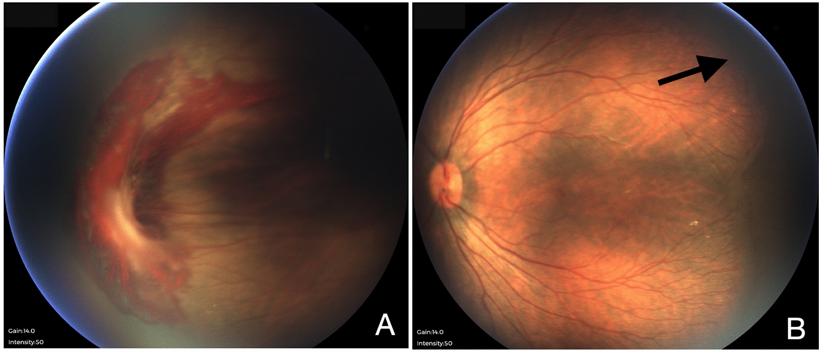 Two fundus photographs of one patient. The right eye has a retinal fold with hemorrhage. The left eye has straight vessels running temporally, and an arrow marks where the vessels stop