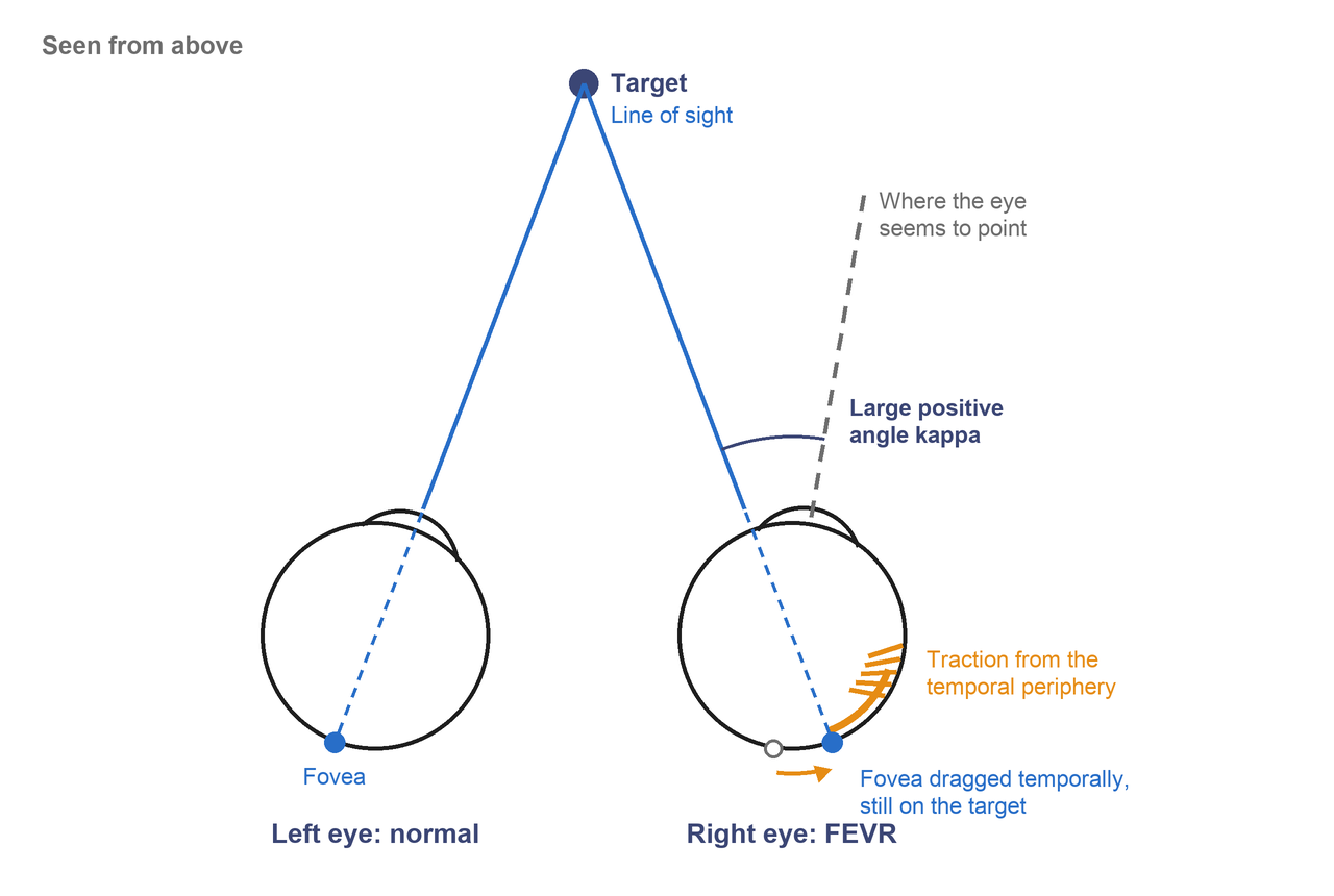 Both eyes seen from above, looking at a target. In the right eye, traction has pulled the fovea temporally. The eye points outward, but its line of sight still reaches the fovea