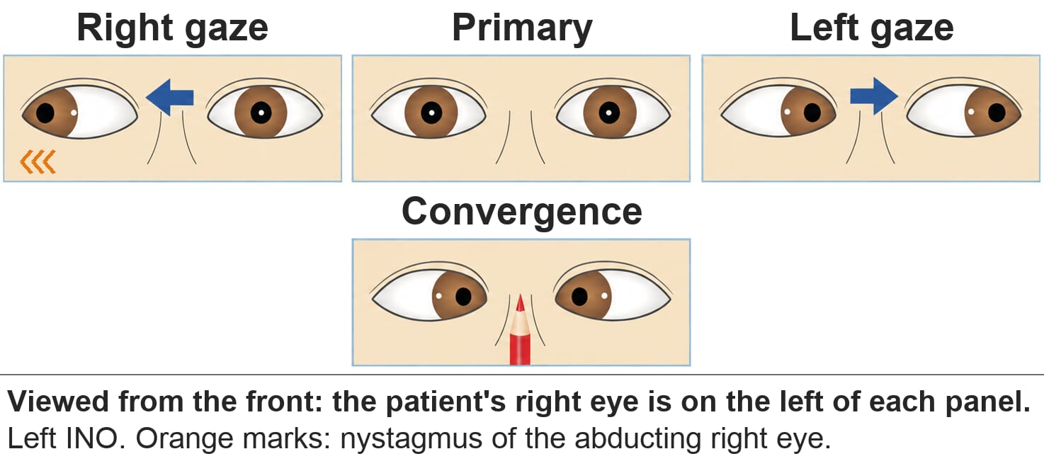 Left internuclear ophthalmoplegia. On right gaze the right eye abducts with nystagmus but the left eye stays in the midline. Left gaze is normal. On convergence both eyes adduct.