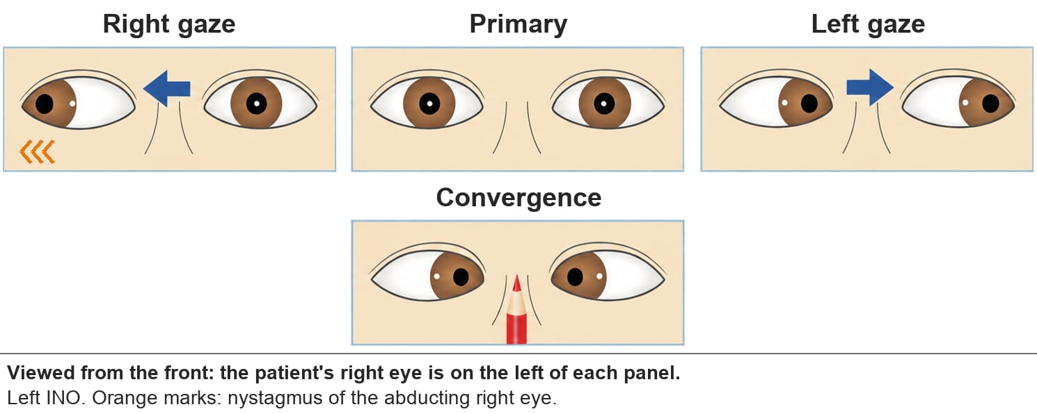 Left internuclear ophthalmoplegia. On right gaze the right eye abducts with nystagmus but the left eye stays in the midline. Left gaze is normal. On convergence both eyes adduct.