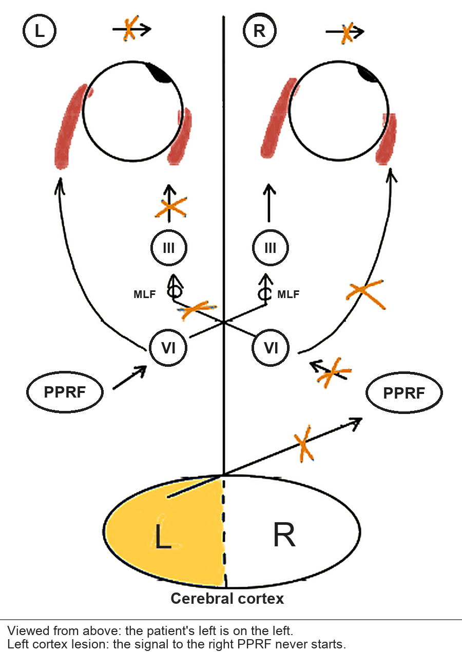 Left cortex lesion on the pathway. The signal for right gaze never leaves the left hemisphere, so nothing reaches the right PPRF.