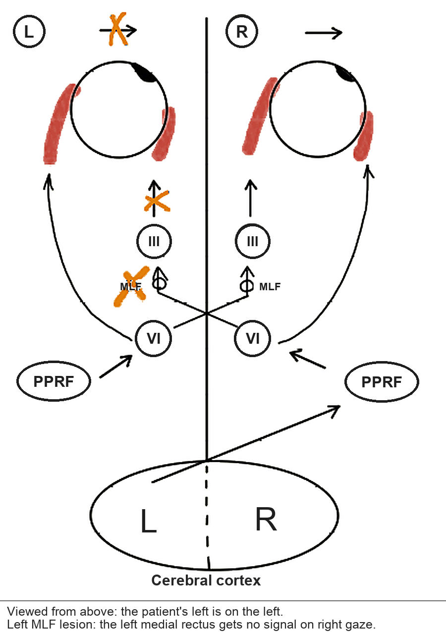 Left MLF lesion on the pathway. The signal from the right VI nucleus stops in the left MLF, so the left medial rectus does not contract on right gaze.