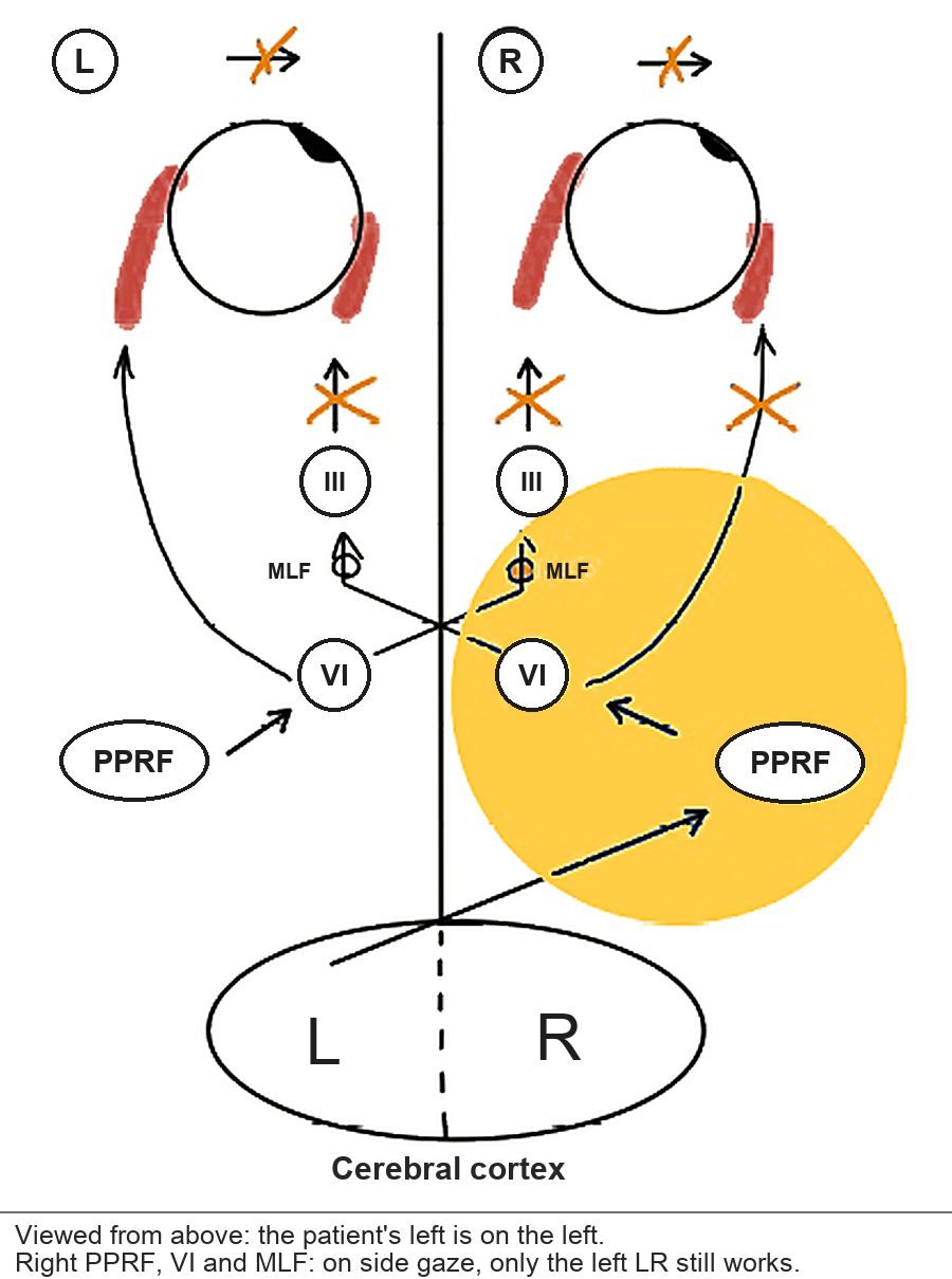 Right one-and-a-half syndrome on the pathway. One lesion covers the right PPRF, the right VI nucleus and the right MLF.