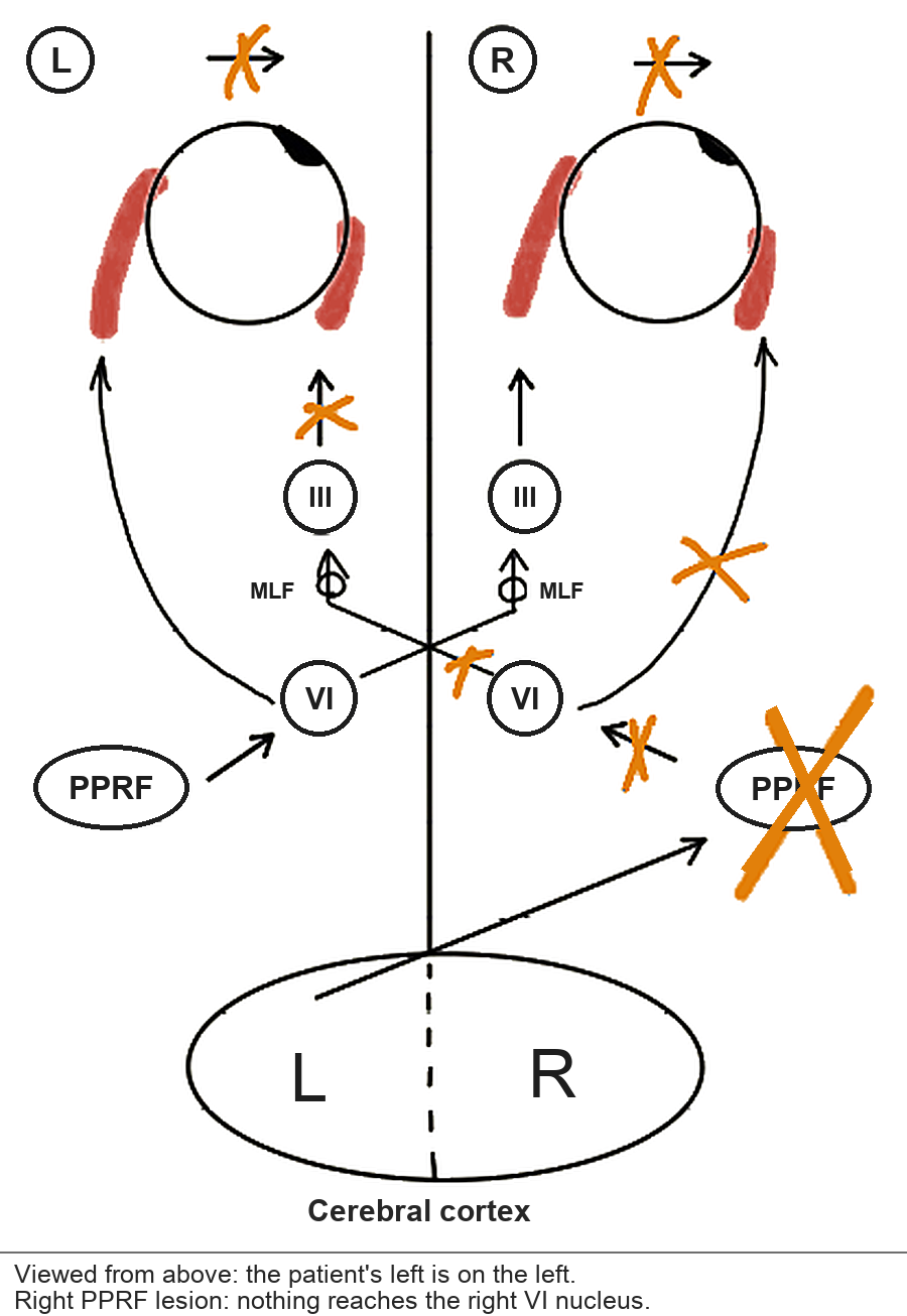 Right PPRF lesion on the pathway. Nothing reaches the right VI nucleus, so neither the right lateral rectus nor the left medial rectus contracts on right gaze.