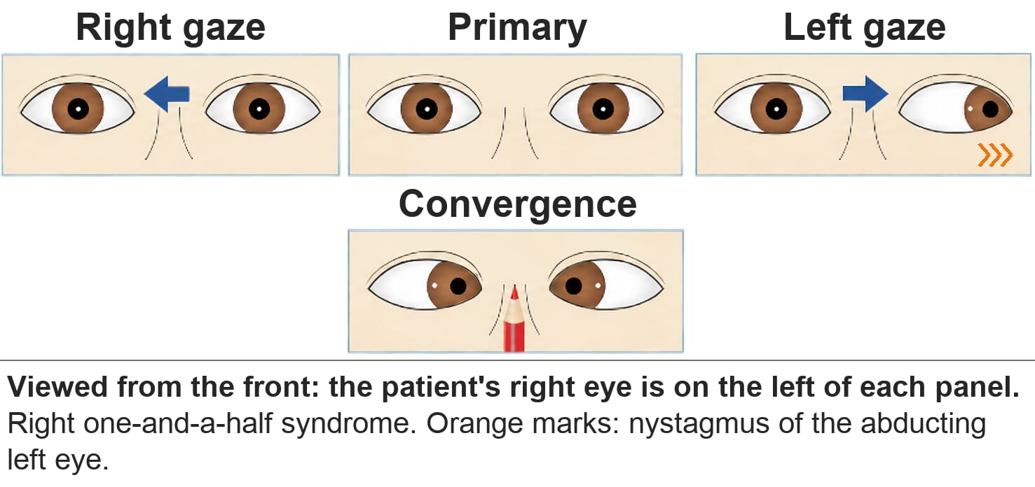 Right one-and-a-half syndrome. On right gaze neither eye moves. On left gaze only the left eye abducts. Convergence is normal.