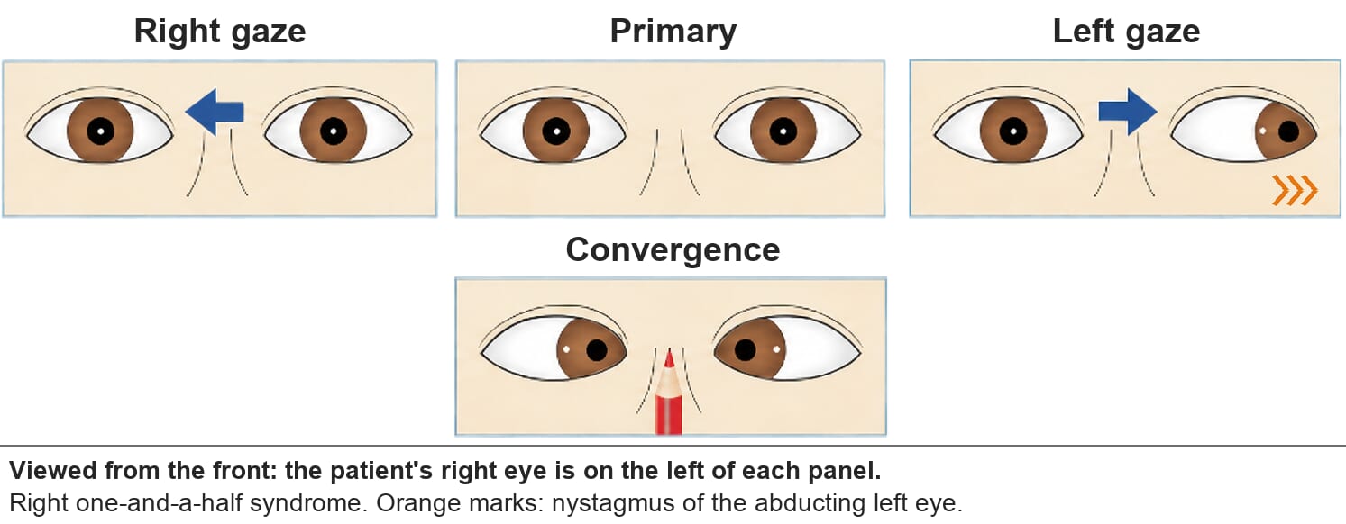 Right one-and-a-half syndrome. On right gaze neither eye moves. On left gaze only the left eye abducts. Convergence is normal.