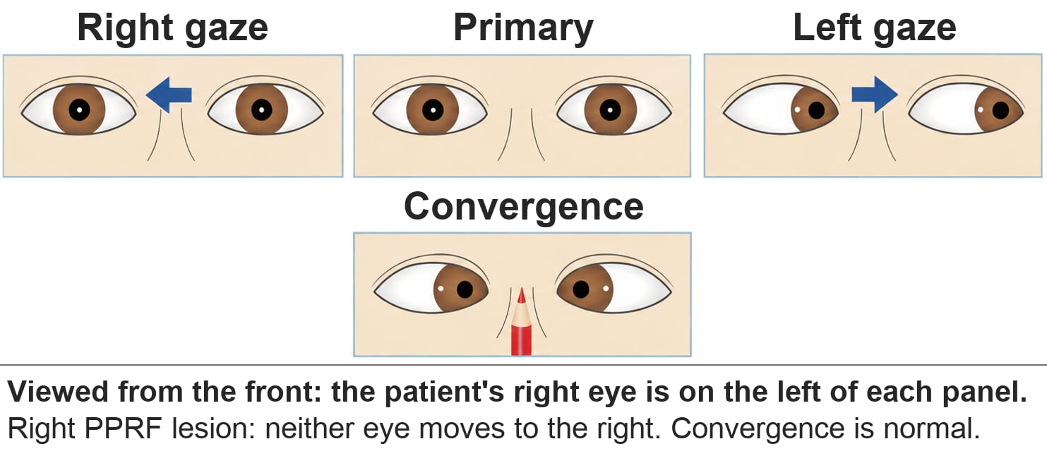 Right PPRF lesion. On right gaze neither eye moves. Left gaze and convergence are normal.