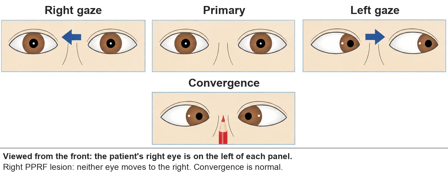 Right PPRF lesion. On right gaze neither eye moves. Left gaze and convergence are normal.