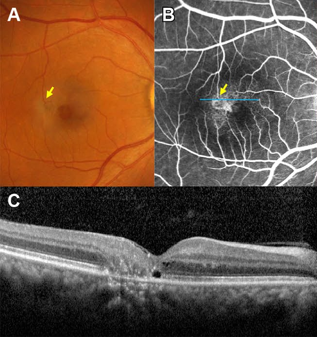 Color fundus photograph, fluorescein angiogram and OCT of the right eye of a 58-year-old woman with MacTel type 2. Arrows point to a right-angled vessel temporal to the fovea. The OCT shows small cavities and a broken ellipsoid zone at the fovea.