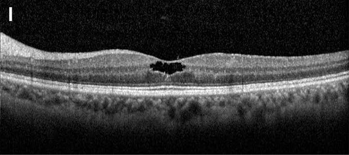 OCT of the left eye of a 59-year-old woman with MacTel type 2, showing a dark cavity in the inner retina under the fovea while the outer retinal lines are preserved.