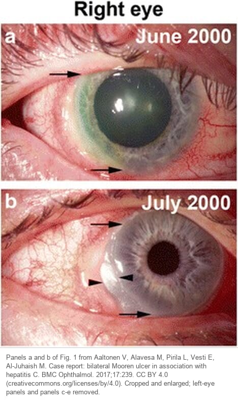 Two photographs of the right eye of a patient with Mooren ulcer. Above, a red eye with a crescent ulcer along the limbus that stains green with fluorescein. Below, a month later, the crescent ulcer runs right up to the limbus with no clear cornea in between