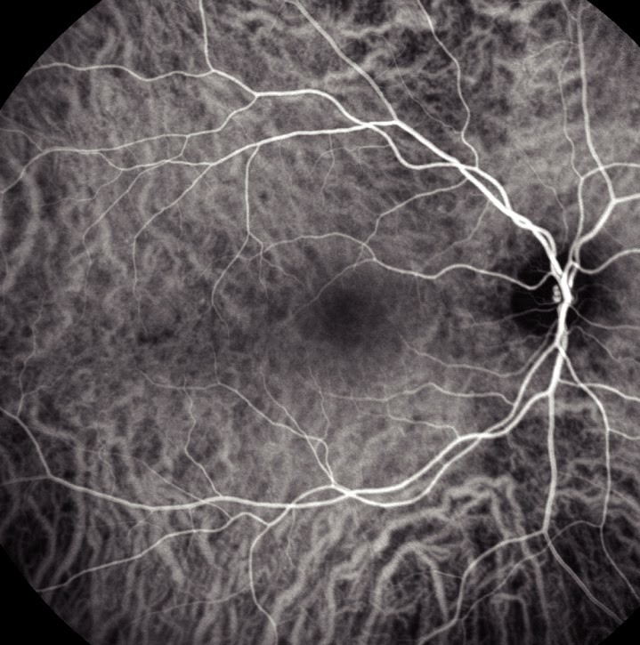 A normal indocyanine green angiogram of a right eye. Bright retinal vessels run over a mesh of wider, softer choroidal vessels that fill the whole background. The macula is slightly darker.