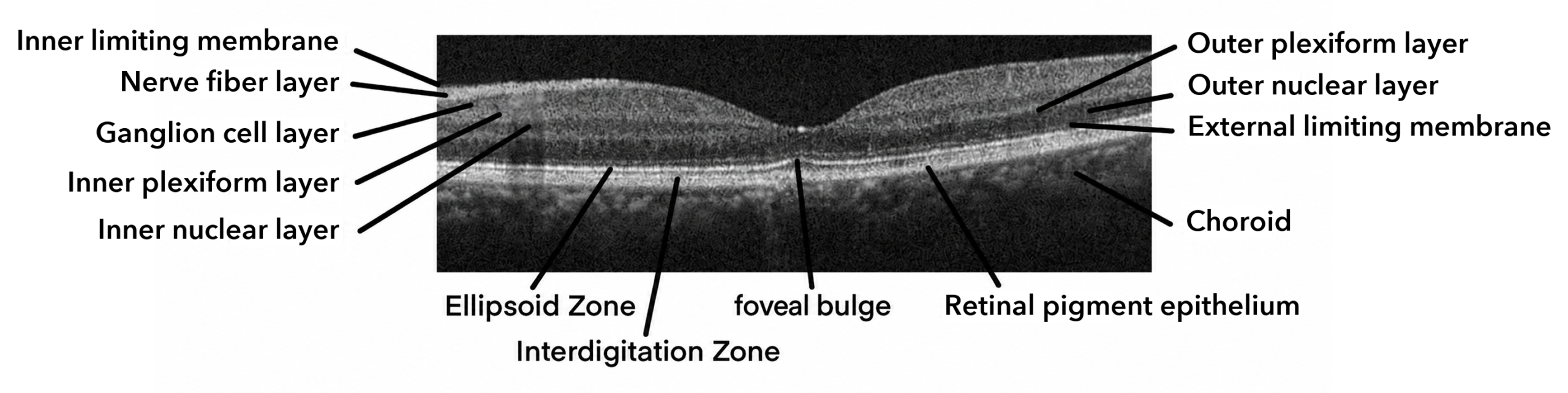 A normal macular OCT through the fovea, with the inner limiting membrane, nerve fiber layer, ganglion cell layer, inner plexiform layer, inner nuclear layer, outer plexiform layer, outer nuclear layer, external limiting membrane, ellipsoid zone, interdigitation zone, retinal pigment epithelium, choroid and foveal bulge labeled.
