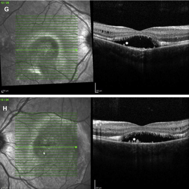 Two OCT scans through the macula, one from each eye of a patient with ARB. Each shows a shallow dome of subretinal fluid under the fovea and small dark cystoid spaces within the inner retina.