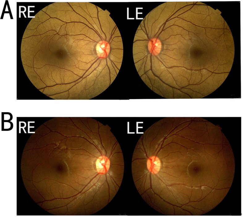 Fundus photographs of both eyes of a patient with Oguchi disease, before and after dark adaptation. In the top row the whole fundus has a golden metallic sheen. In the bottom row the same eyes look a normal red-brown color.
