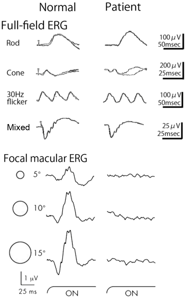 Full-field ERG and focal macular ERG of a normal subject and a patient with occult macular dystrophy. The patient's full-field ERG looks like the normal one, but the focal macular ERG is almost flat.