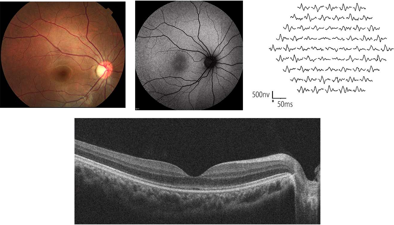 Color fundus photograph, fundus autofluorescence image and multifocal ERG on top, and an OCT scan through the fovea below, from one patient with Miyake disease