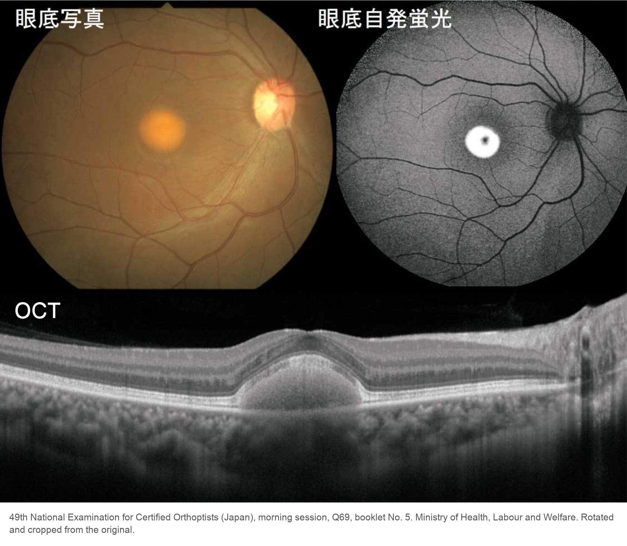 Best disease: color fundus photograph with a round yellow-orange lesion at the macula, autofluorescence image in which the lesion is intensely bright, and OCT showing a dome of material beneath the fovea