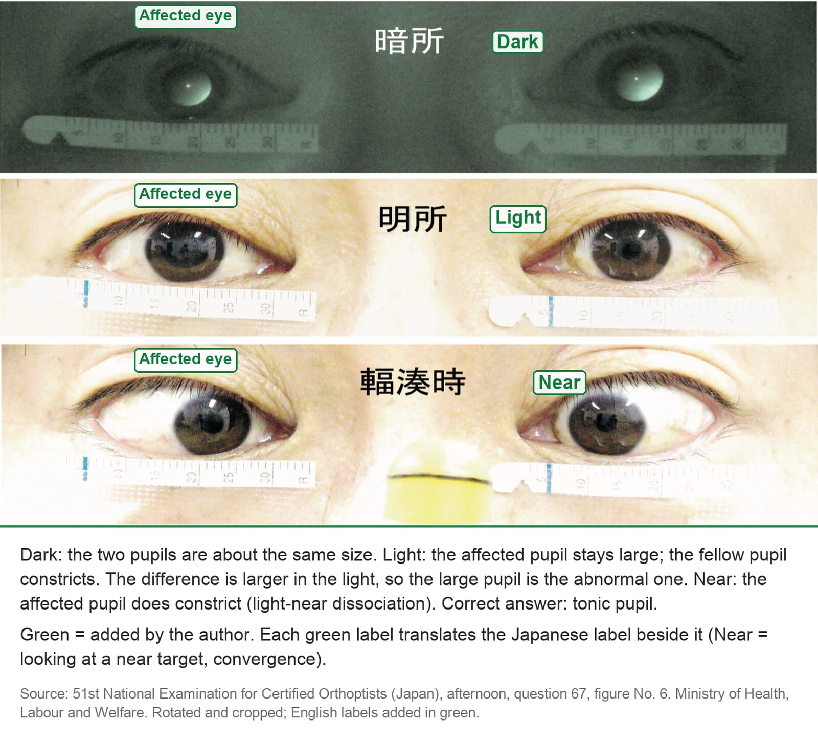 Both eyes of one patient photographed in the dark, in the light and while looking at a near target: the pupils are about equal in the dark, the affected pupil stays large in the light, and it constricts for near