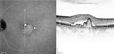 Left, an indocyanine green angiogram of the macula with two small bright round spots next to a patch of fine bright network. Right, an OCT scan of the same eye showing a steep pigment epithelial detachment with fluid around it.