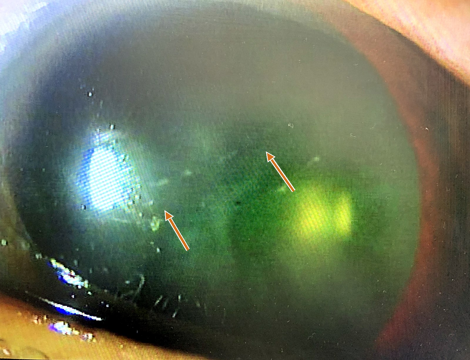 Slit-lamp photograph of a cornea with a posterior corneal vesicle: a band-like lesion on the posterior corneal surface, with the limbus at the lower left