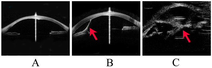 Three images of Peters anomaly. A: anterior segment OCT with a defect at the back of the central cornea. B: anterior segment OCT with a strand from the iris to the cornea, marked by a red arrow. C: ultrasound biomicroscopy with a strand between the lens and the cornea, marked by a red arrow.