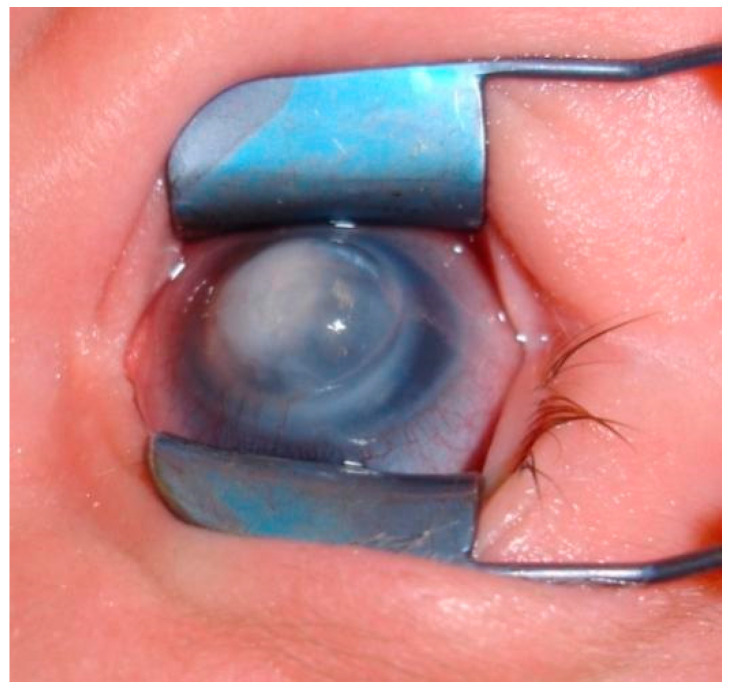 An infant's eye held open with a speculum. A dense white opacity covers the center of the cornea. The cornea is large and bluish around the opacity.