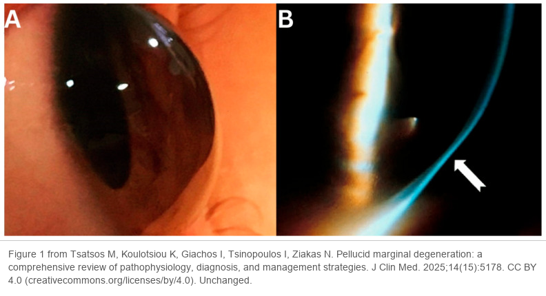 Two slit-lamp photographs of pellucid marginal degeneration. On the left, the inferior cornea is thin and the cornea just above it bulges forward. On the right, a slit beam shows the thinnest part of the cornea near the inferior limbus, marked with an arrow