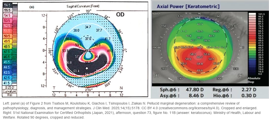 Two corneal curvature maps side by side. On the left, pellucid marginal degeneration: a steep band in the inferior cornea curves up on both sides around a flatter central zone, like a crab's claw. On the right, keratoconus: the steepest area is a round zone just below the center, reaching about 61 diopters