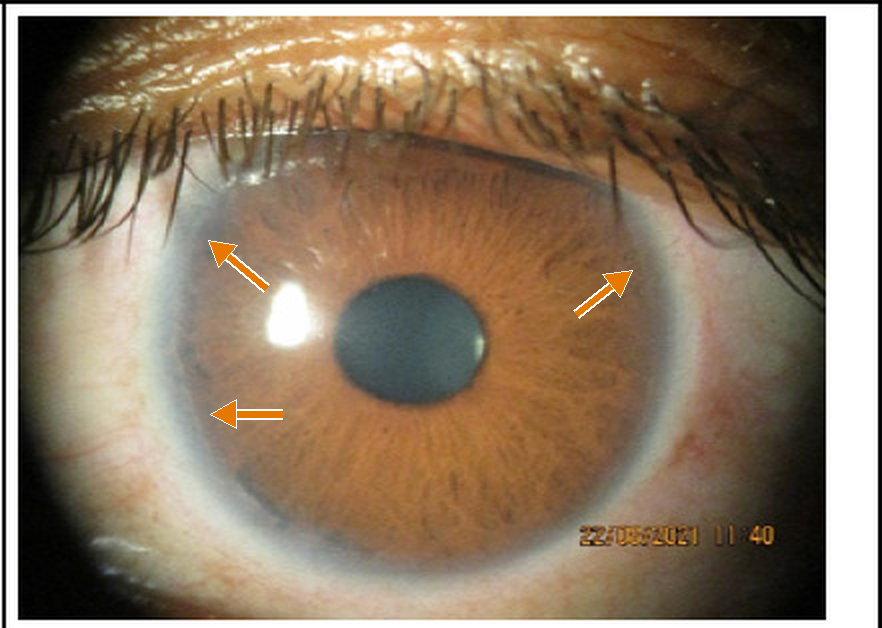 A brown iris with a round pupil. A thin white ring runs just inside the limbus all the way around the cornea. Three orange arrows point to the ring.