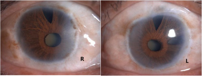 Both eyes of one patient. The iris stroma is thin, and there is a triangular full-thickness hole in the iris above the pupil in each eye. The lenses are cloudy from cataract.