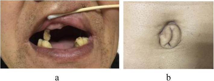 Left: an open mouth with only a few upper and lower teeth. Right: a navel with extra folds of skin around it.