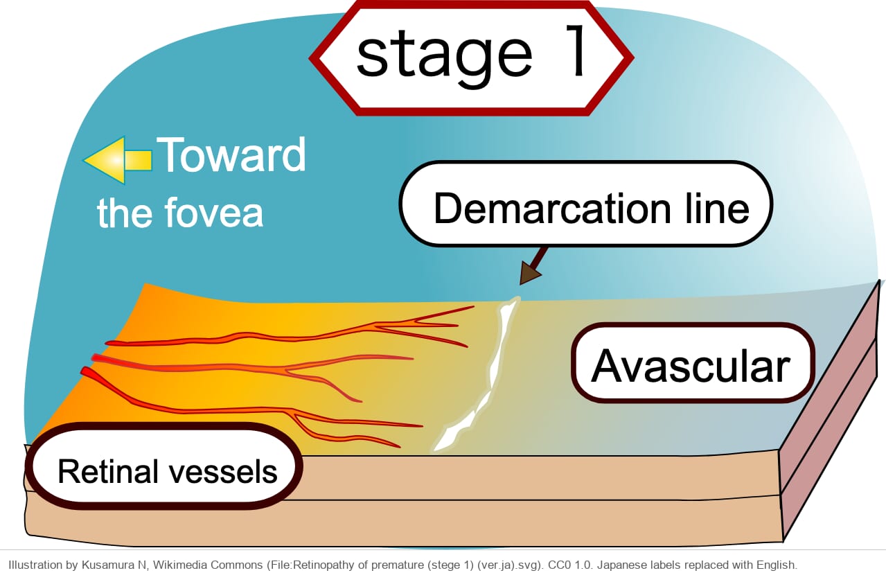 Drawing of the retina in cross-section with vessels on the left, a thin white line in the middle and avascular retina on the right