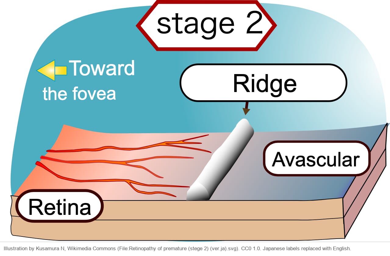 Drawing of the retina with a raised white ridge between the vascularized and the avascular retina