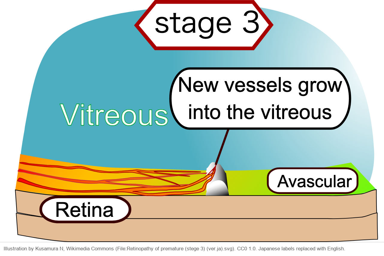 Drawing of the ridge with new vessels growing up from it into the vitreous