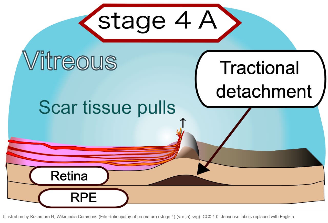 Drawing of scar tissue on the ridge pulling on the retina, with the retina lifted off next to the ridge