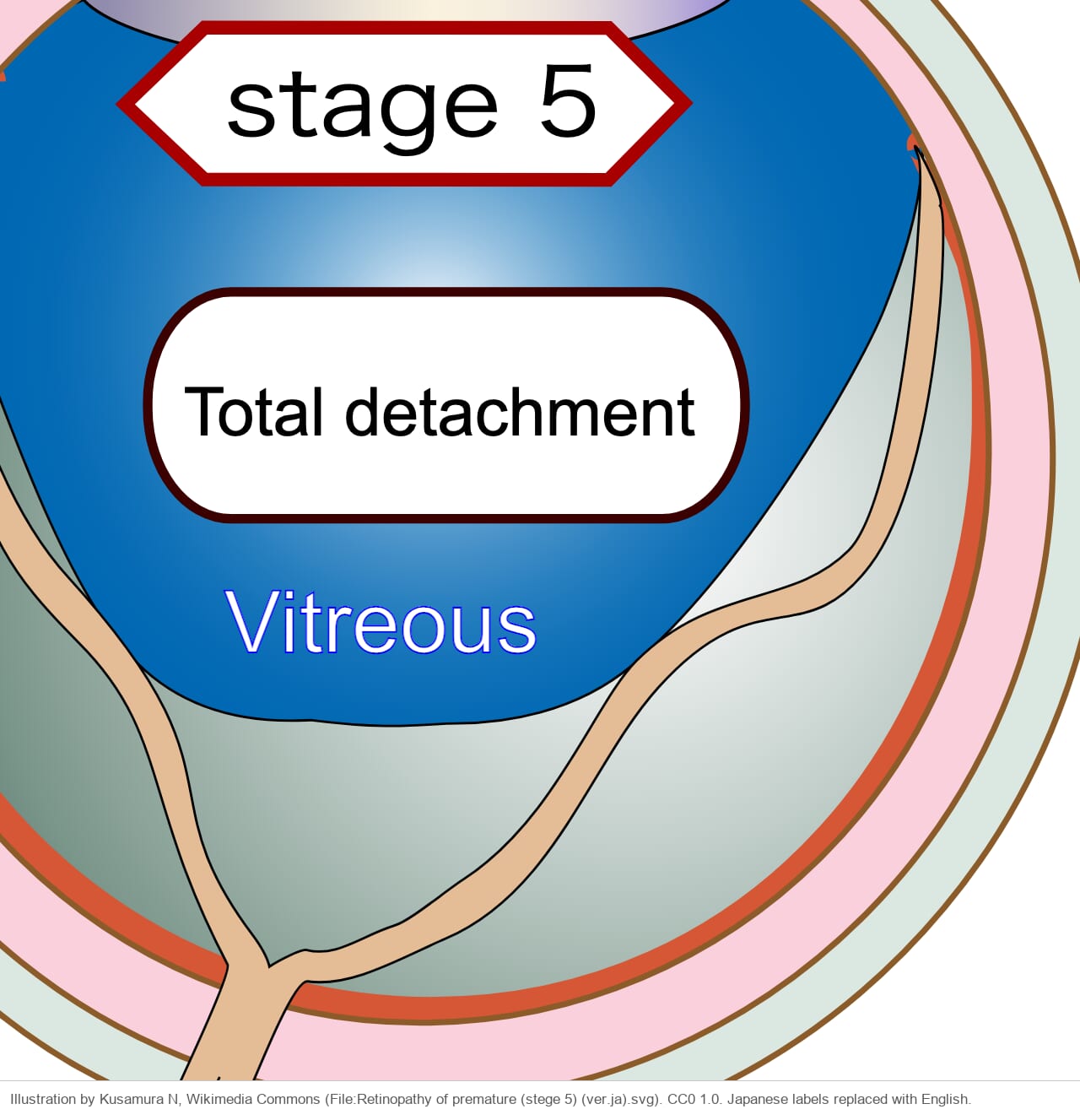 Drawing of an eye in cross-section with the whole retina detached into a funnel