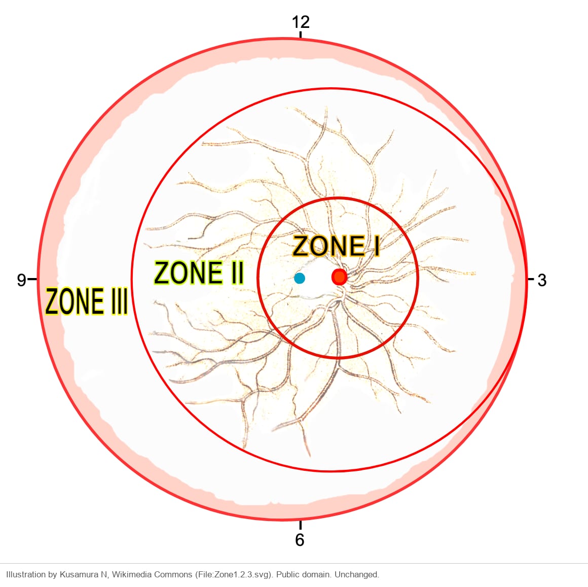 Three circles centered on the optic disc of a right eye. The small inner circle is zone I, the middle circle reaching the nasal edge is zone II, and the outer temporal crescent is zone III
