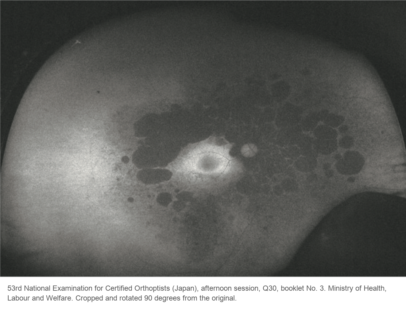 Wide-field fundus autofluorescence image of an eye with retinitis pigmentosa. Many dark round patches merge in the mid-periphery, and a bright area surrounds the macula.