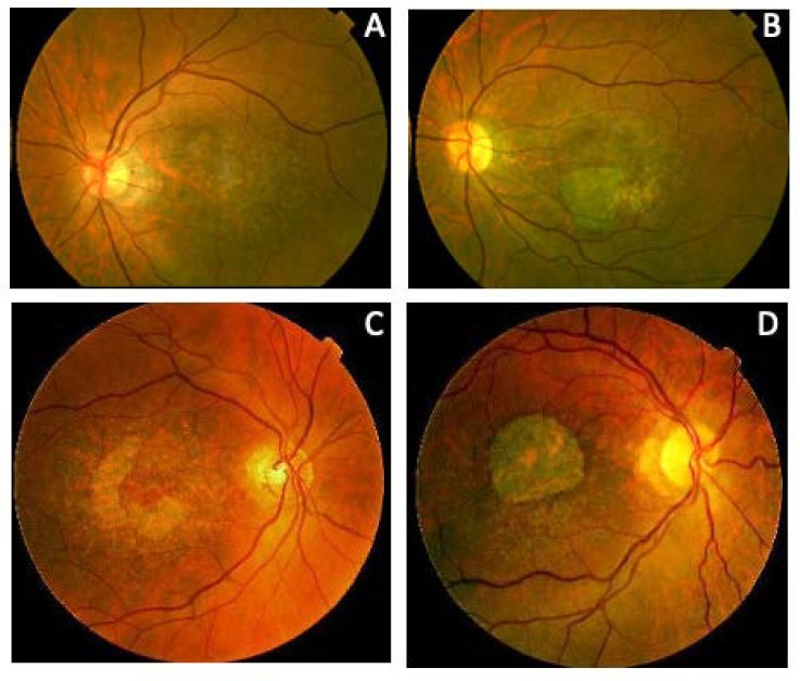 Four color fundus photographs of the macula in one family with CACD. The first shows only fine whitish stippling at the macula. The second shows a pale round patch beginning at the macula. The third shows atrophy around the fovea, with the fovea spared. The fourth shows a large, sharply demarcated area of atrophy covering the macula.