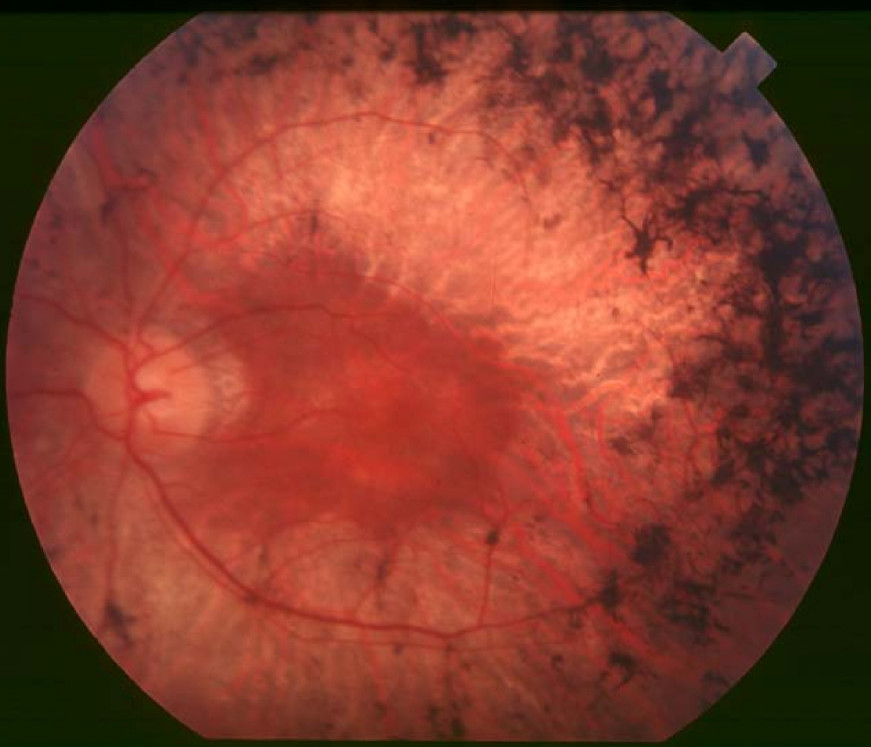 Fundus photograph of an eye with retinitis pigmentosa. Black, branching pigment clumps fill the mid-periphery on the right side of the image. The vessels are thin, and the macula still looks red.