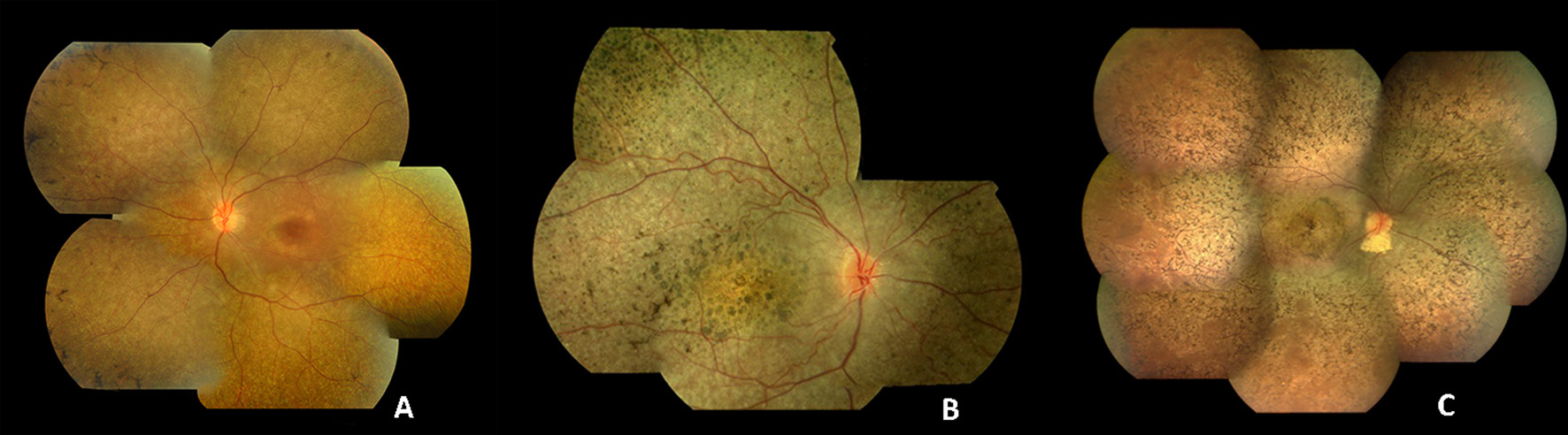 Three wide-field fundus photographs of children with different genetic types of LCA. The first fundus is pale and blond with a normal-looking macula. The second has round pigment clumps in the periphery and an atrophic macula. The third has dense dark pigment all over the retina and an atrophic macula.