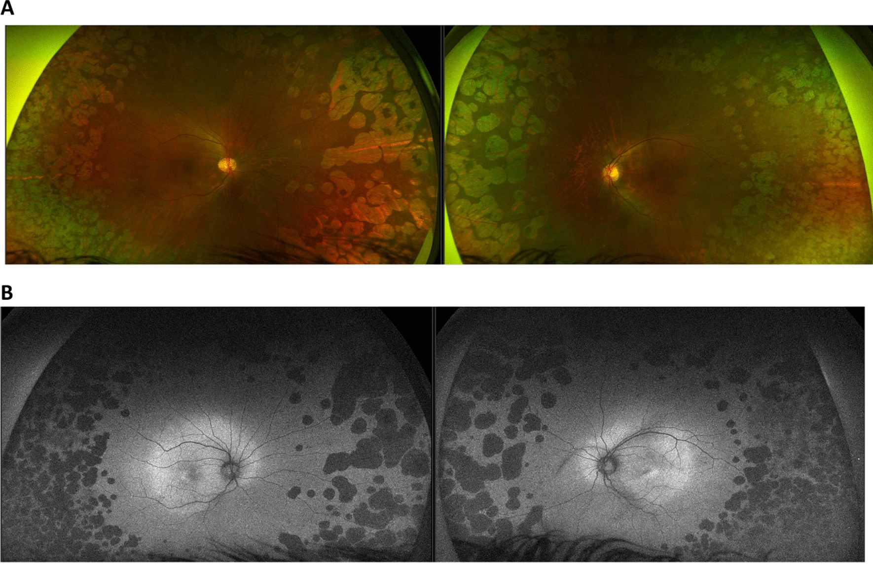 Wide-field color fundus photographs and fundus autofluorescence images of both eyes in gyrate atrophy. Many round and scalloped patches of atrophy with sharp borders surround the posterior pole, which looks normal. On autofluorescence the patches are dark.