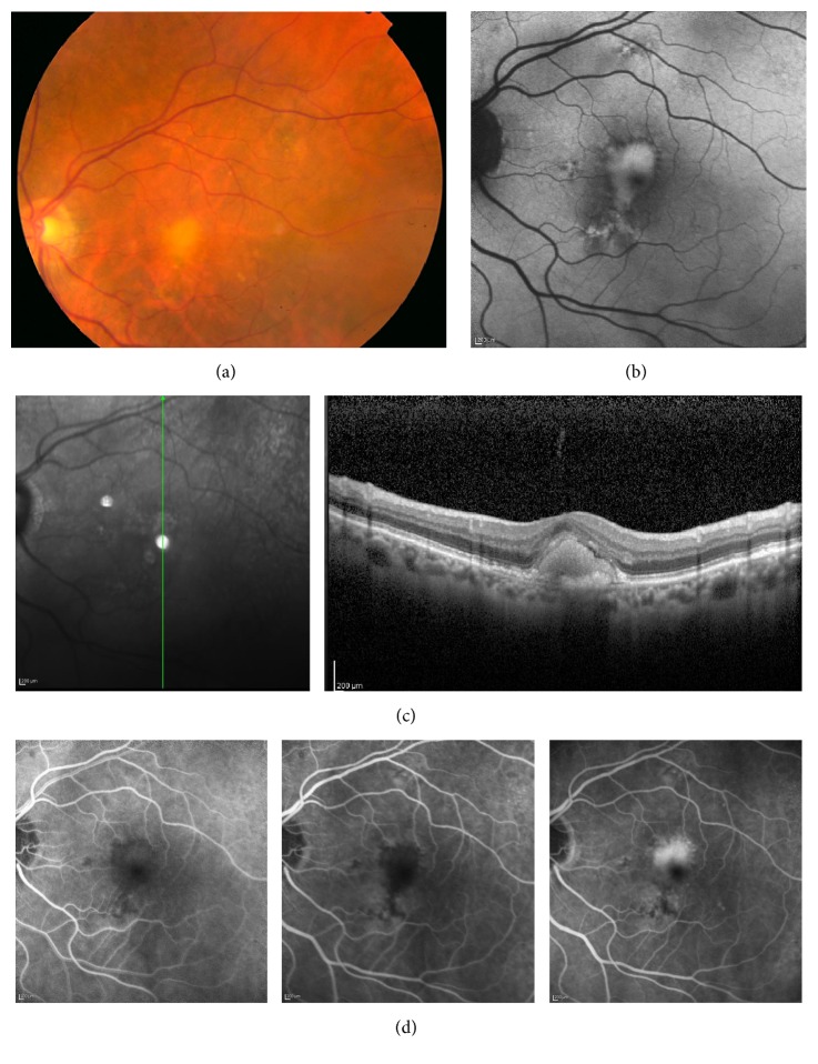 Four panels of one eye with an acquired vitelliform lesion. The color photograph shows a yellow deposit at the macula with a few drusen. The autofluorescence image shows the deposit as a bright patch. The OCT scan shows a dome of bright material above the RPE. Three fluorescein angiography frames show the lesion dark early and bright late.